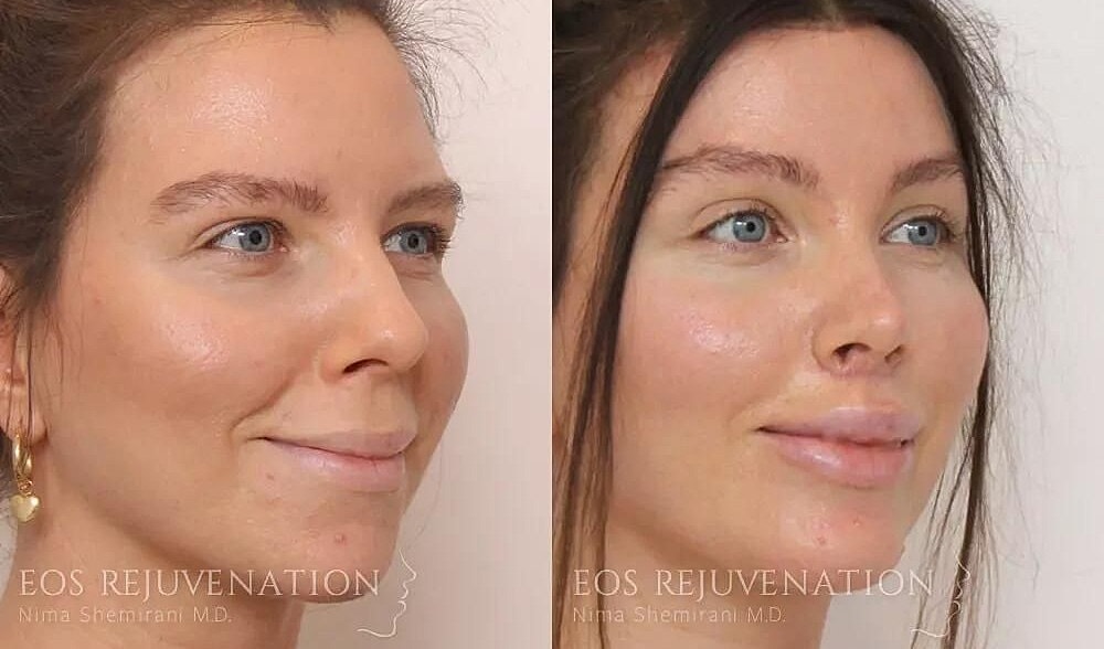 Rhinoplasty Before & After