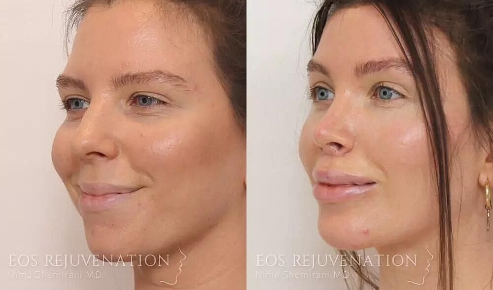 Rhinoplasty Before & After