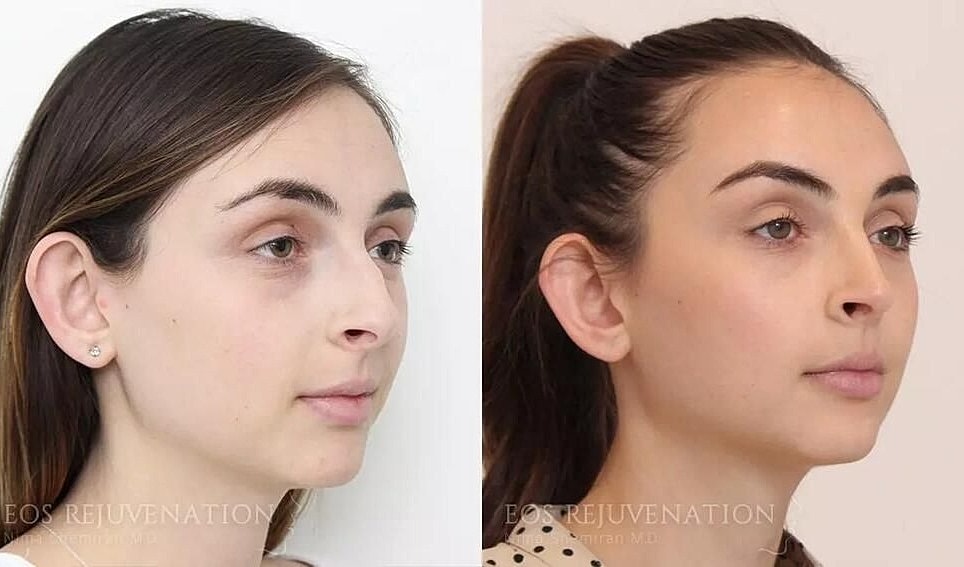 Rhinoplasty Before & After