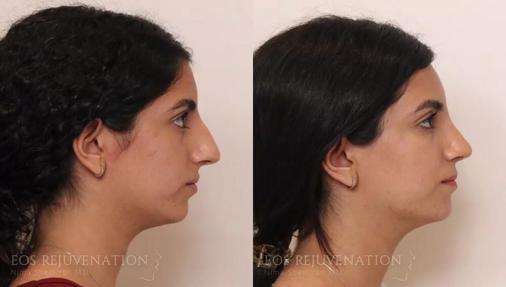 Rhinoplasty Before & After