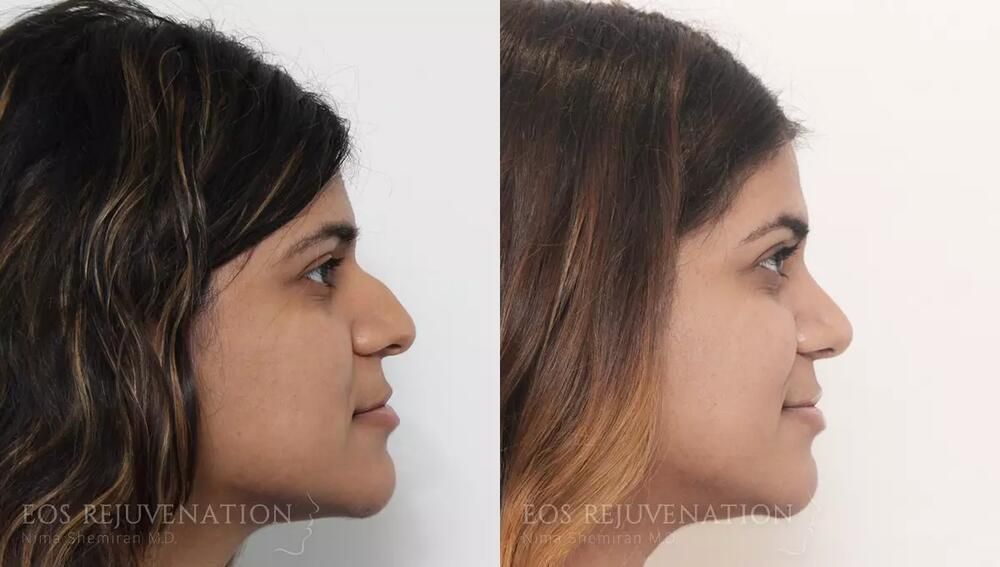 Rhinoplasty Before & After