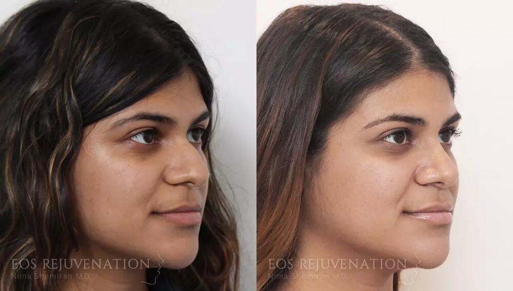 Rhinoplasty Before & After