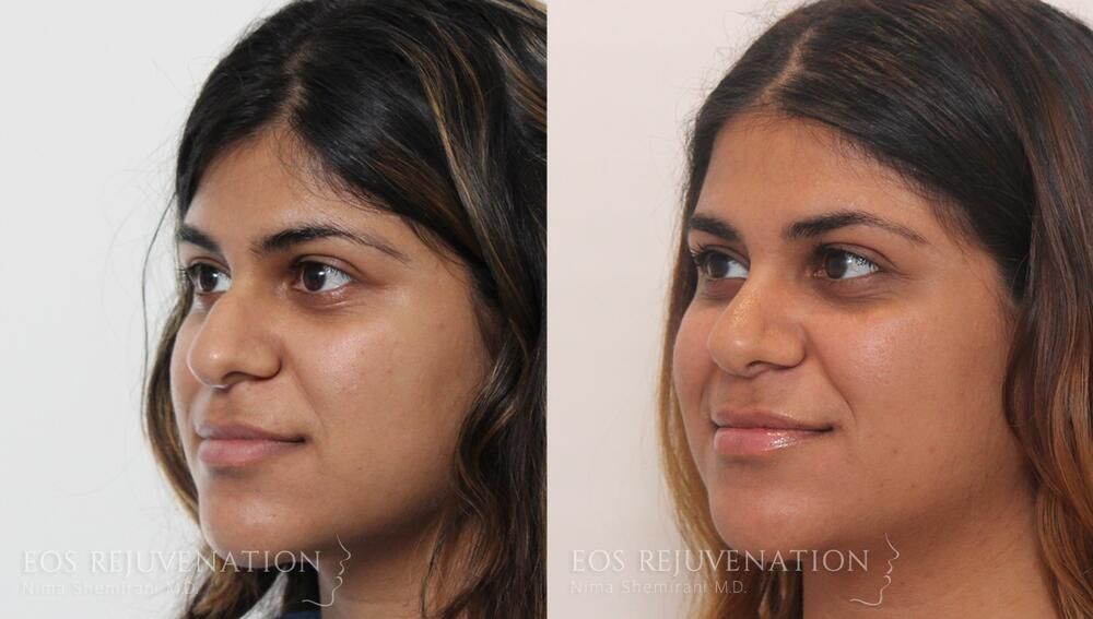 Rhinoplasty Before & After