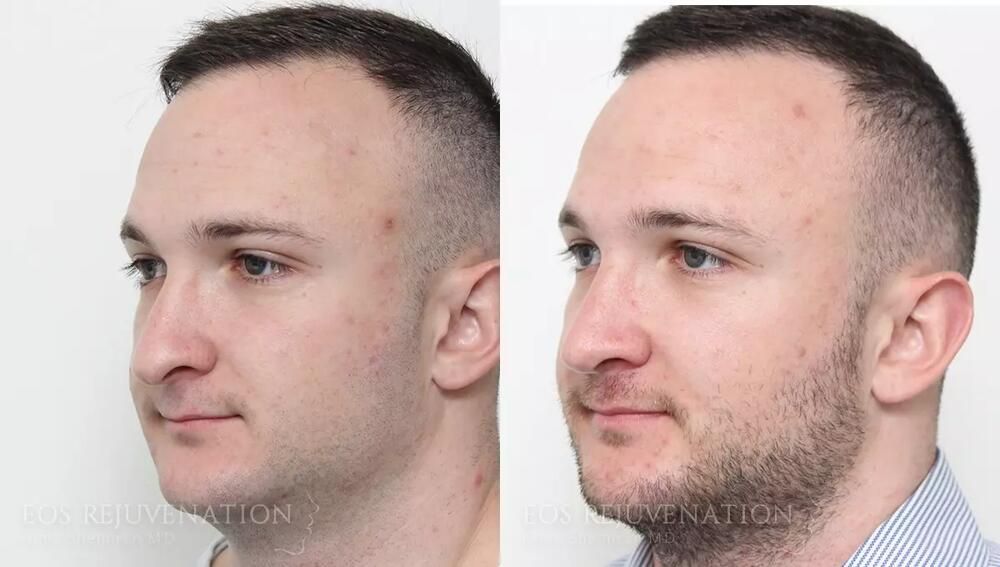 Rhinoplasty Before & After