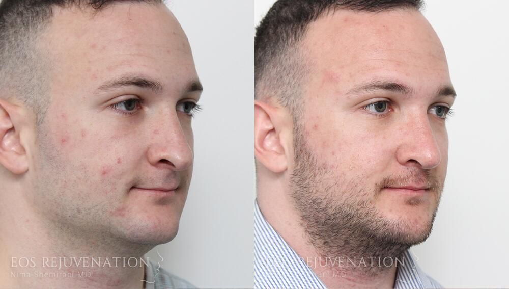 Rhinoplasty Before & After