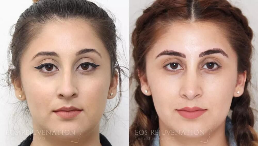 Rhinoplasty Before & After