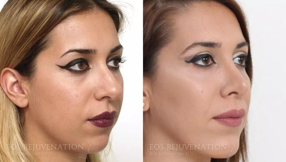 Rhinoplasty Before & After