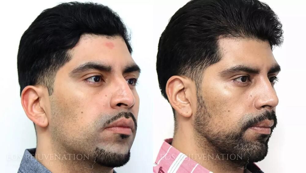 Rhinoplasty Before & After