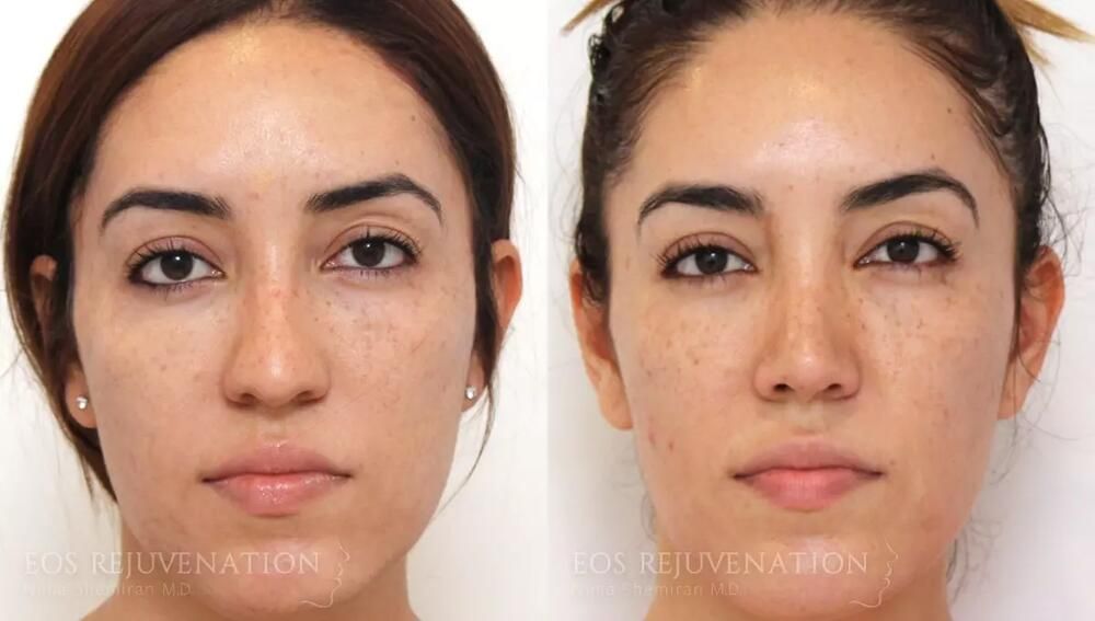 Rhinoplasty Before & After