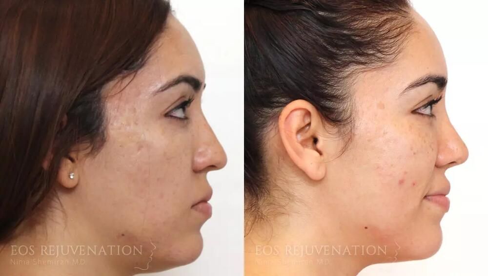 Rhinoplasty Before & After