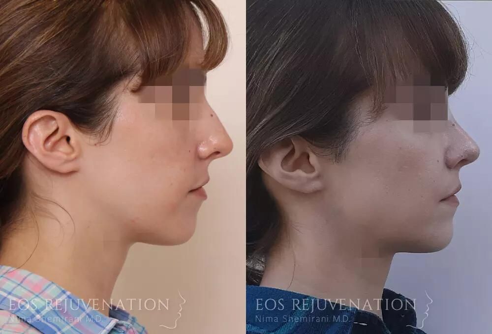 Rhinoplasty Before & After