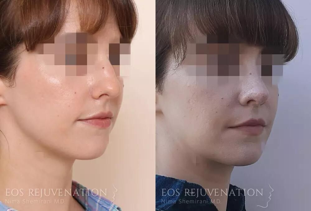 Rhinoplasty Before & After
