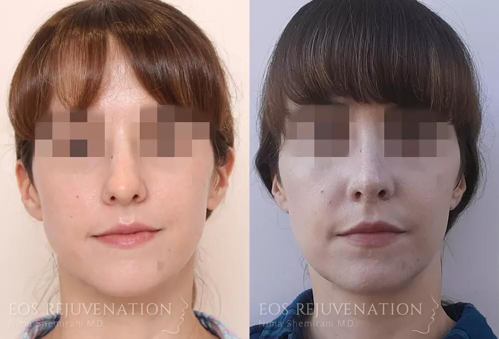 Rhinoplasty Before & After