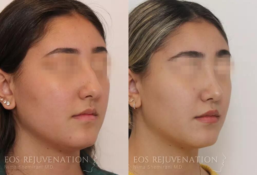 Rhinoplasty Before & After