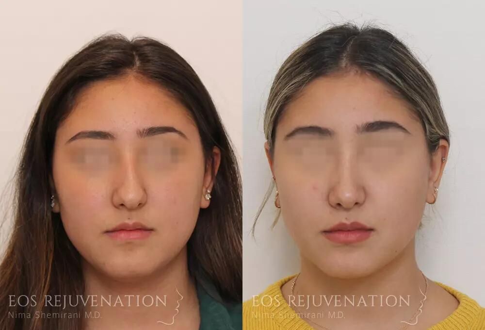 Rhinoplasty Before & After