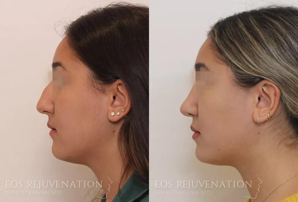 Rhinoplasty Before & After