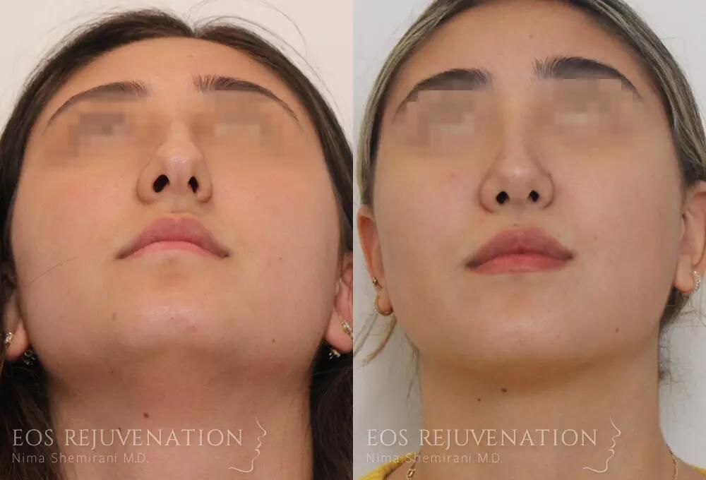 Rhinoplasty Before & After
