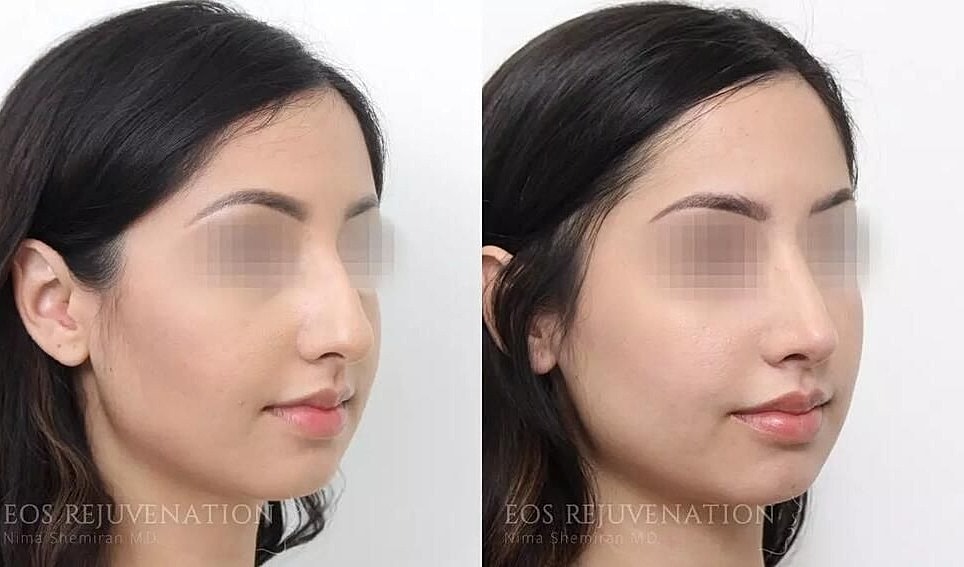 Rhinoplasty Before & After