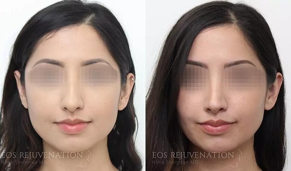 Rhinoplasty Before & After
