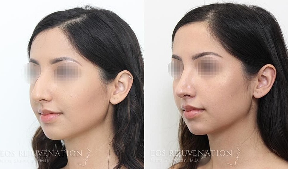 Rhinoplasty Before & After