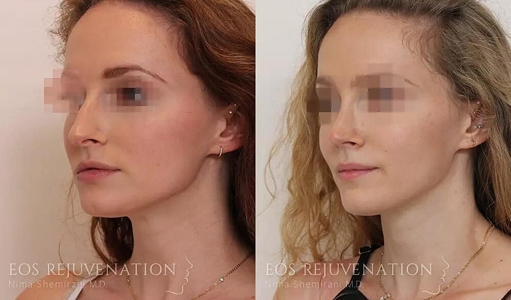 Rhinoplasty Before & After