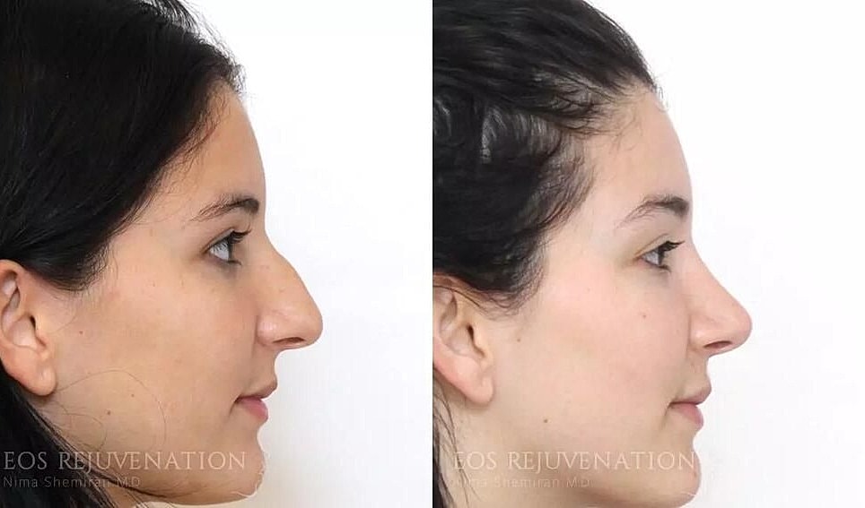 Rhinoplasty Before & After