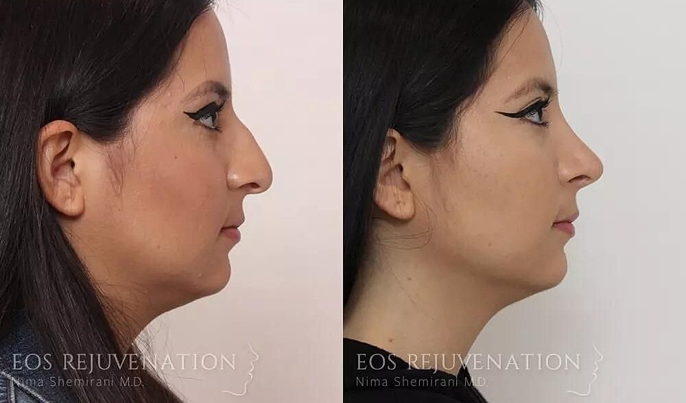 Rhinoplasty Before & After