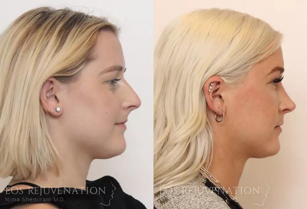 Rhinoplasty Before & After