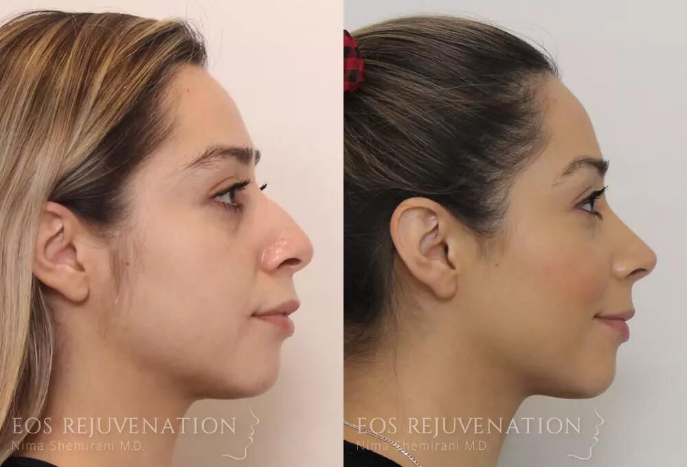 Rhinoplasty Before & After