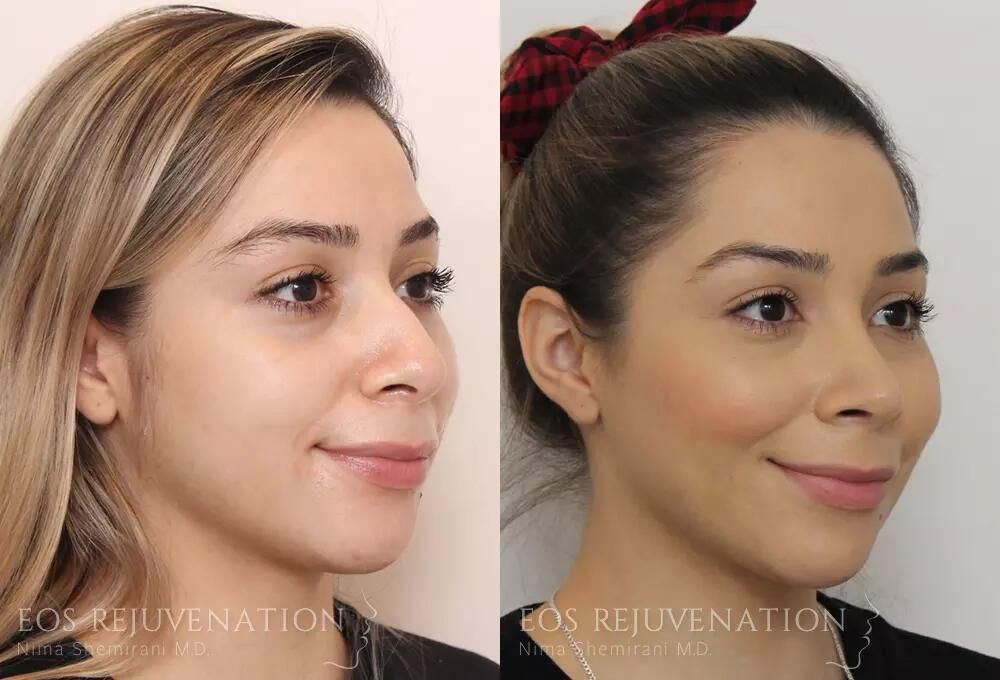 Rhinoplasty Before & After