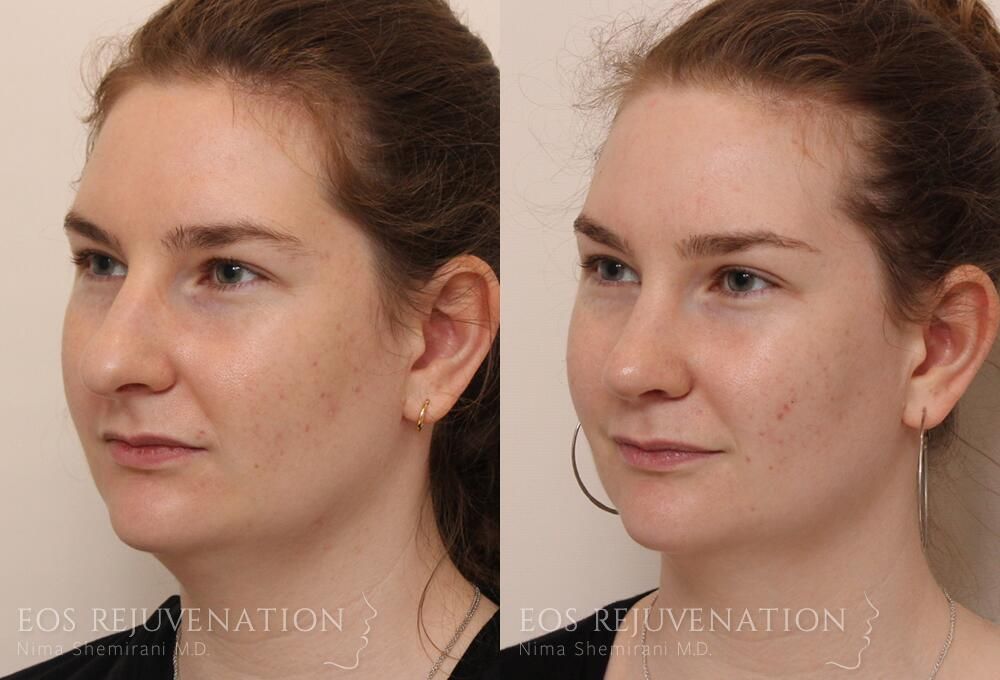 Rhinoplasty Before & After