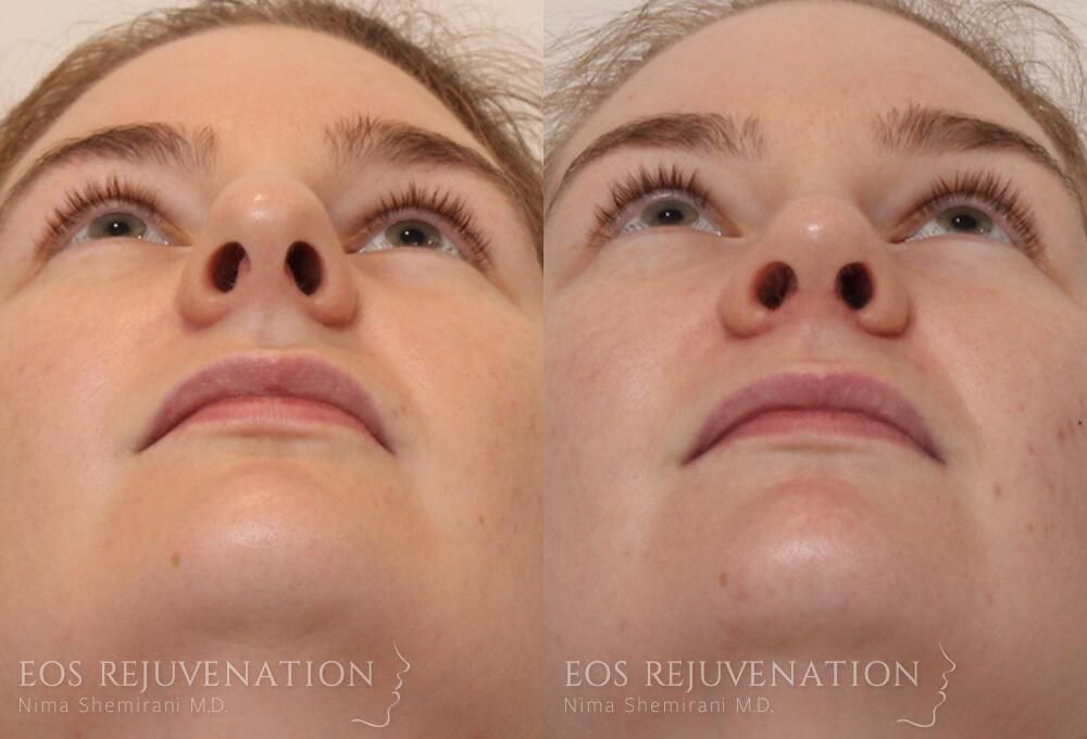 Rhinoplasty Before & After