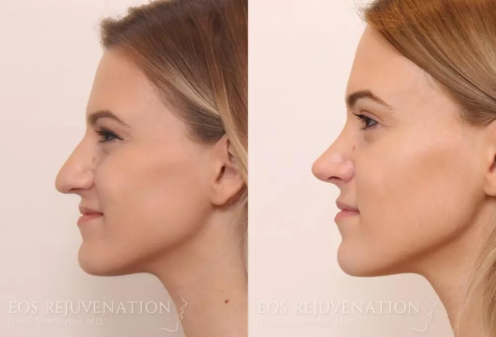 Rhinoplasty Before & After
