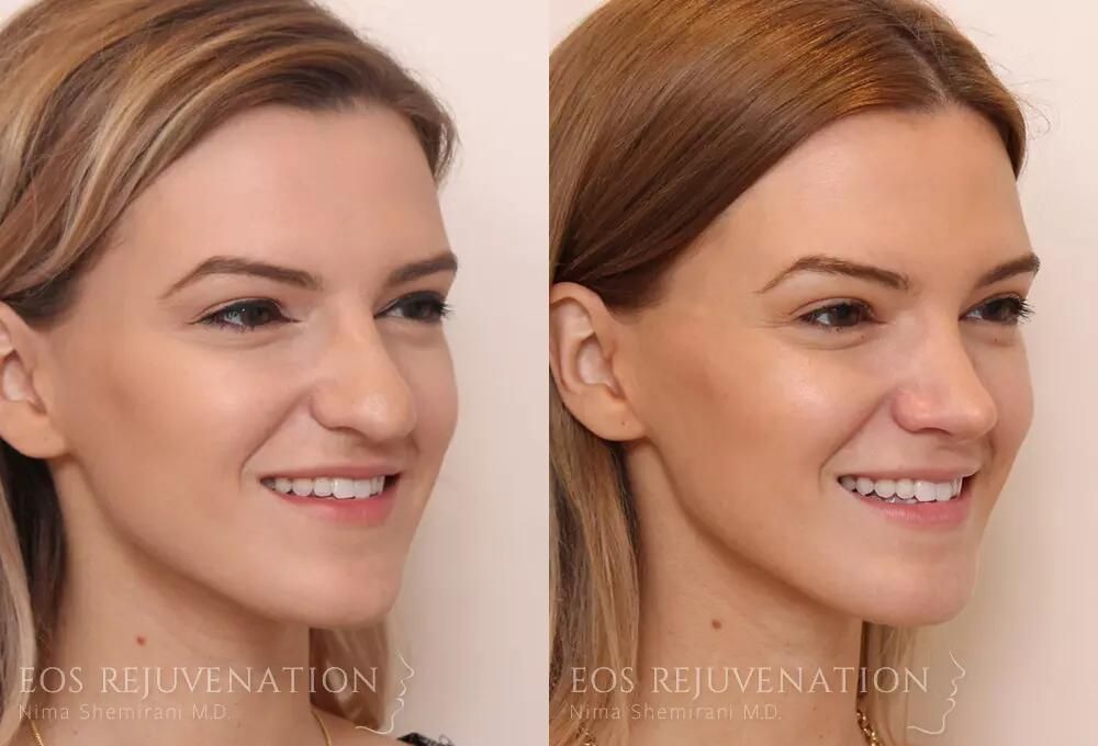 Rhinoplasty Before & After