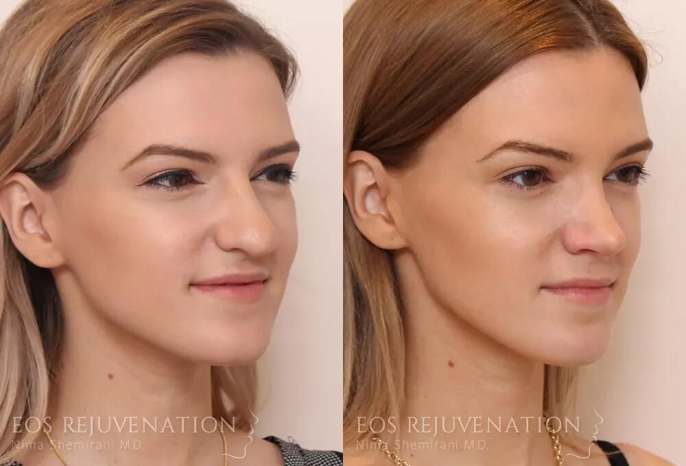 Rhinoplasty Before & After