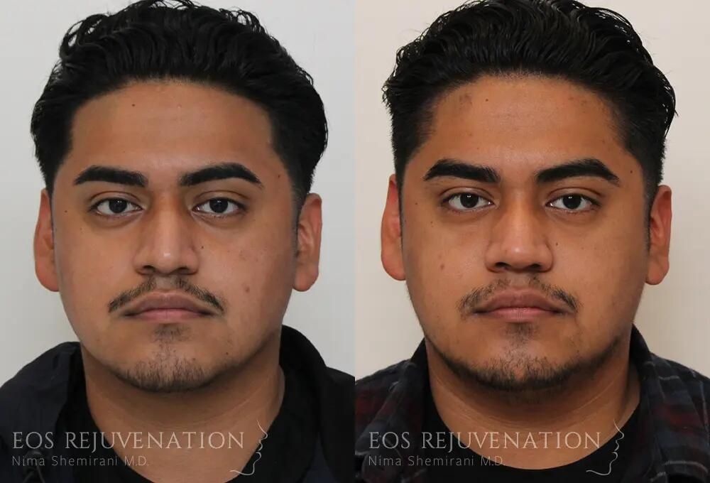 Rhinoplasty Before & After