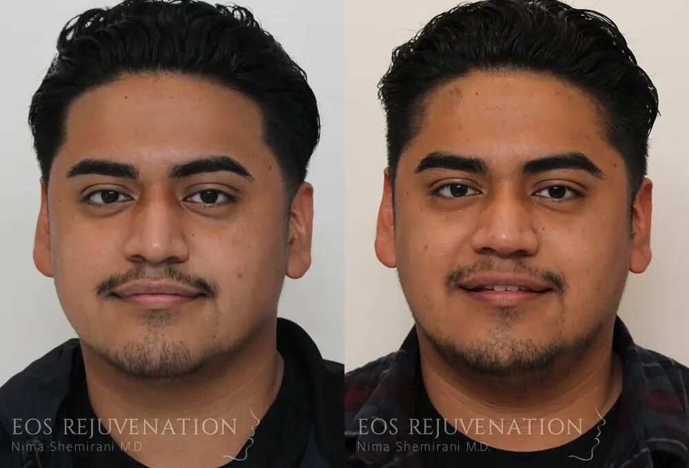 Rhinoplasty Before & After