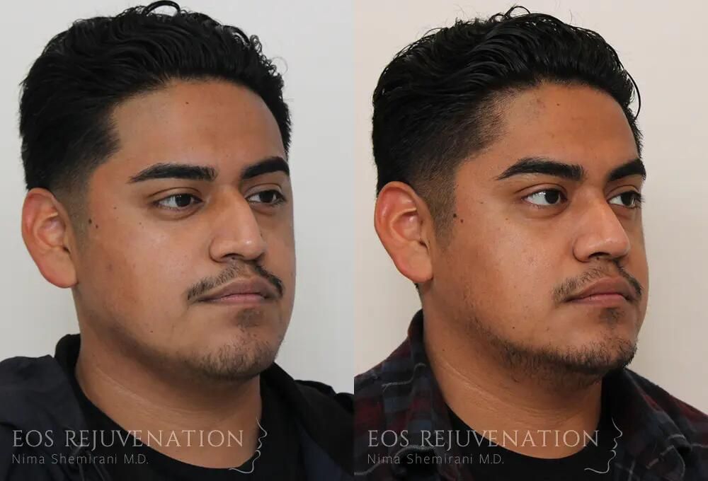 Rhinoplasty Before & After