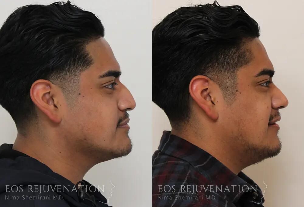 Rhinoplasty Before & After