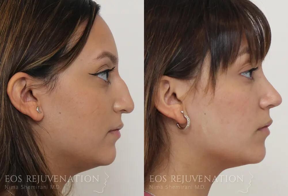 Rhinoplasty Before & After