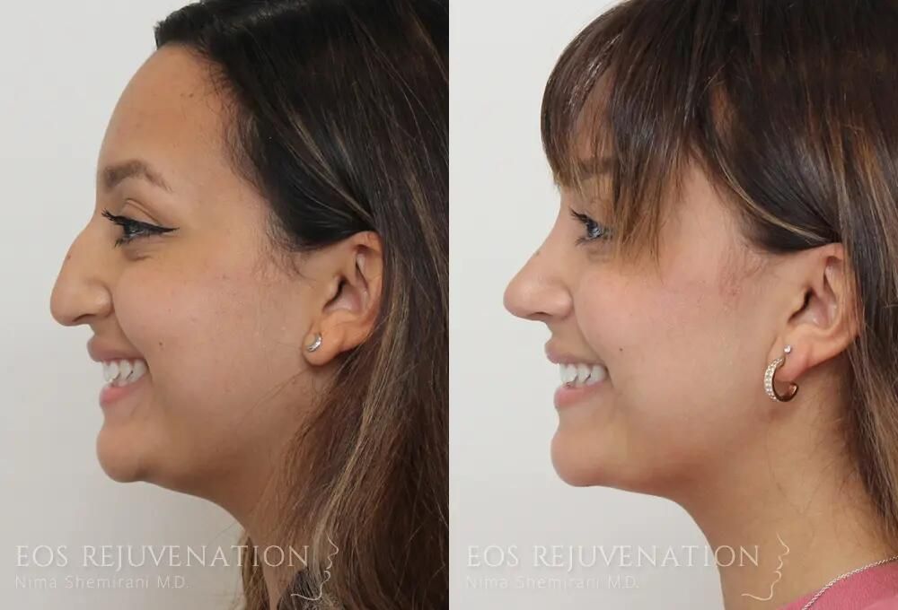 Rhinoplasty Before & After