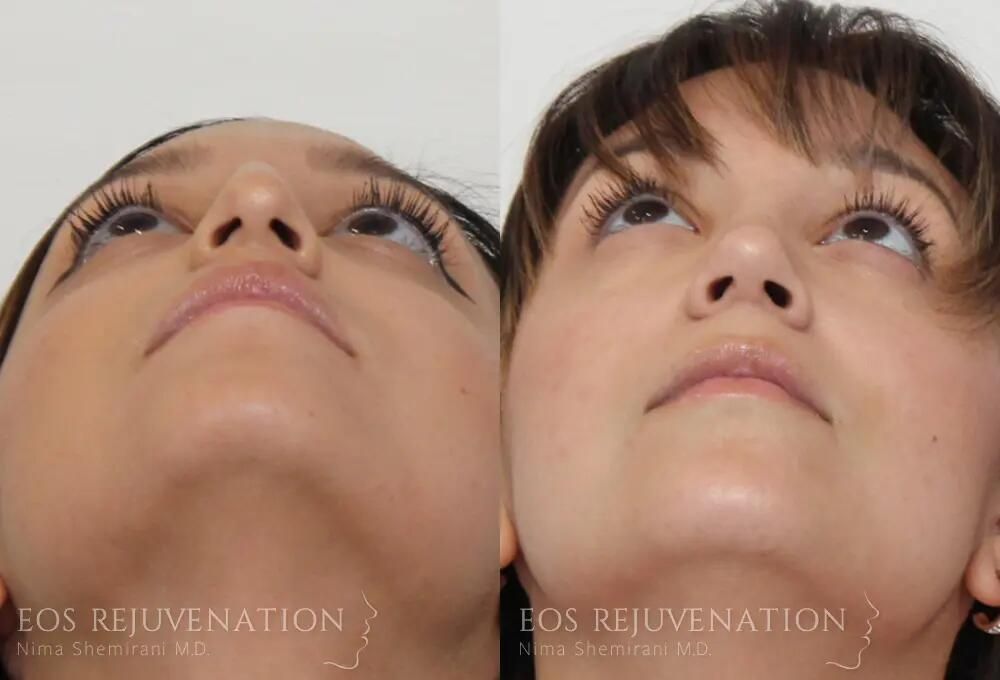 Rhinoplasty Before & After