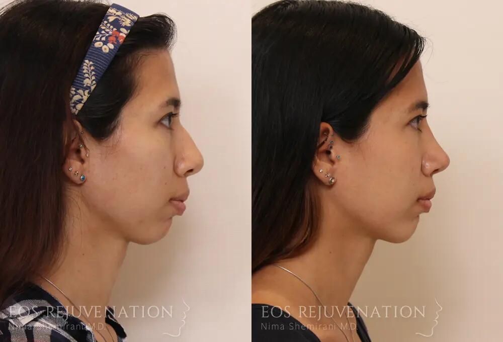 Rhinoplasty Before & After