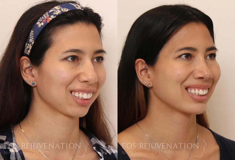 Rhinoplasty Before & After
