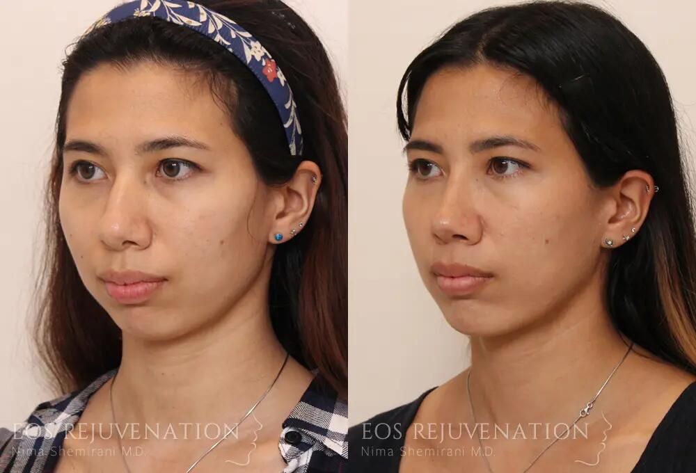 Rhinoplasty Before & After