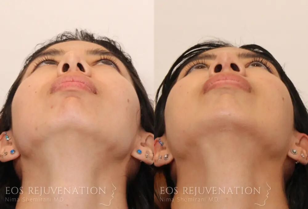 Rhinoplasty Before & After