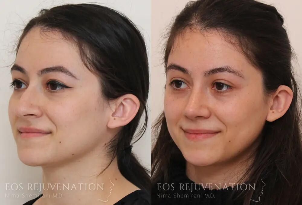 Rhinoplasty Before & After