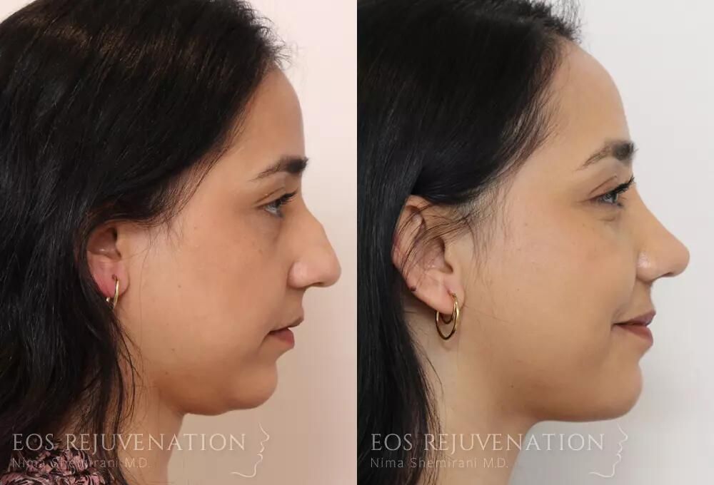 Rhinoplasty Before & After