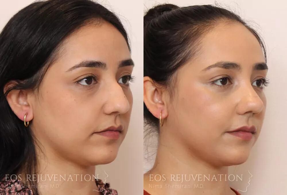 Rhinoplasty Before & After