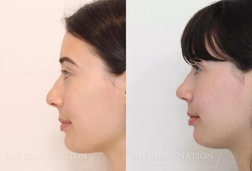 Rhinoplasty Before & After